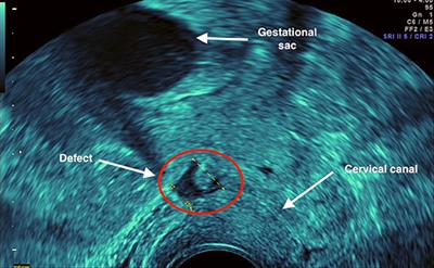 Frontiers | Case Report: Laparoscopic Isthmocele Repair On An 8 Weeks ...